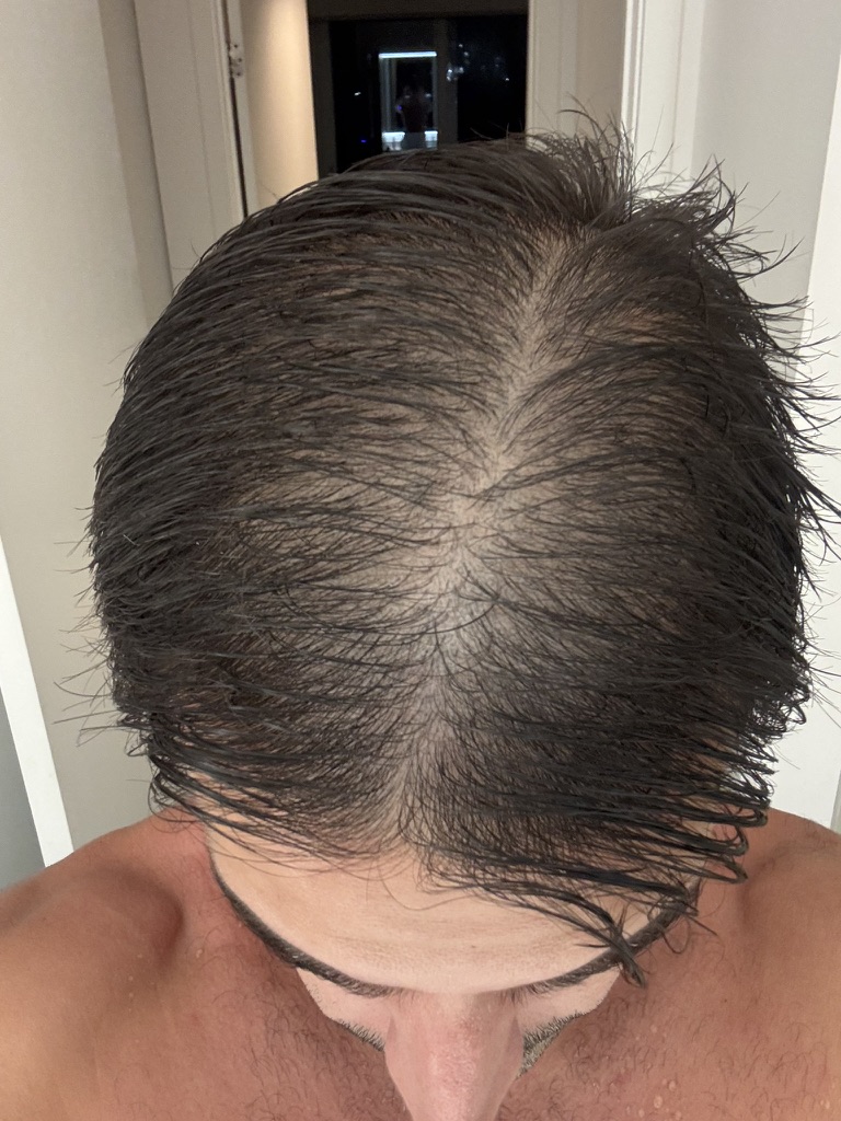 Visible regrowth — Month 6 – 9